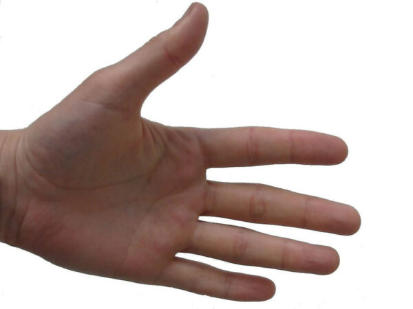 Школьницу избавили  от потных ладошек